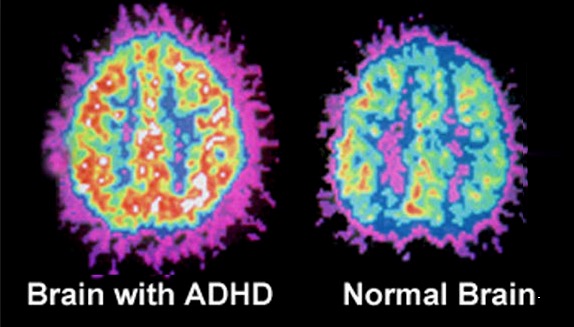 Differences In Brain Structure For Children With ADHD - Pathways