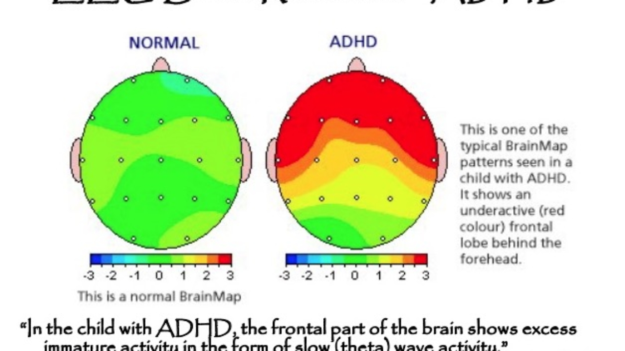 Differences In Brain For Children With ADHD ADHD Specialists