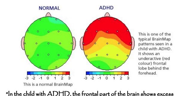 Differences In Brain Structure For Children With ADHD