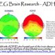 Differences In Brain Structure For Children With ADHD