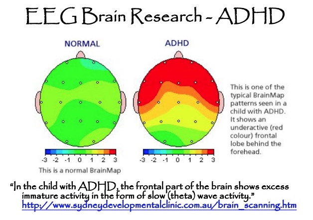 Differences In Brain Structure For Children With ADHD