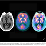 Hypertension & Dementia